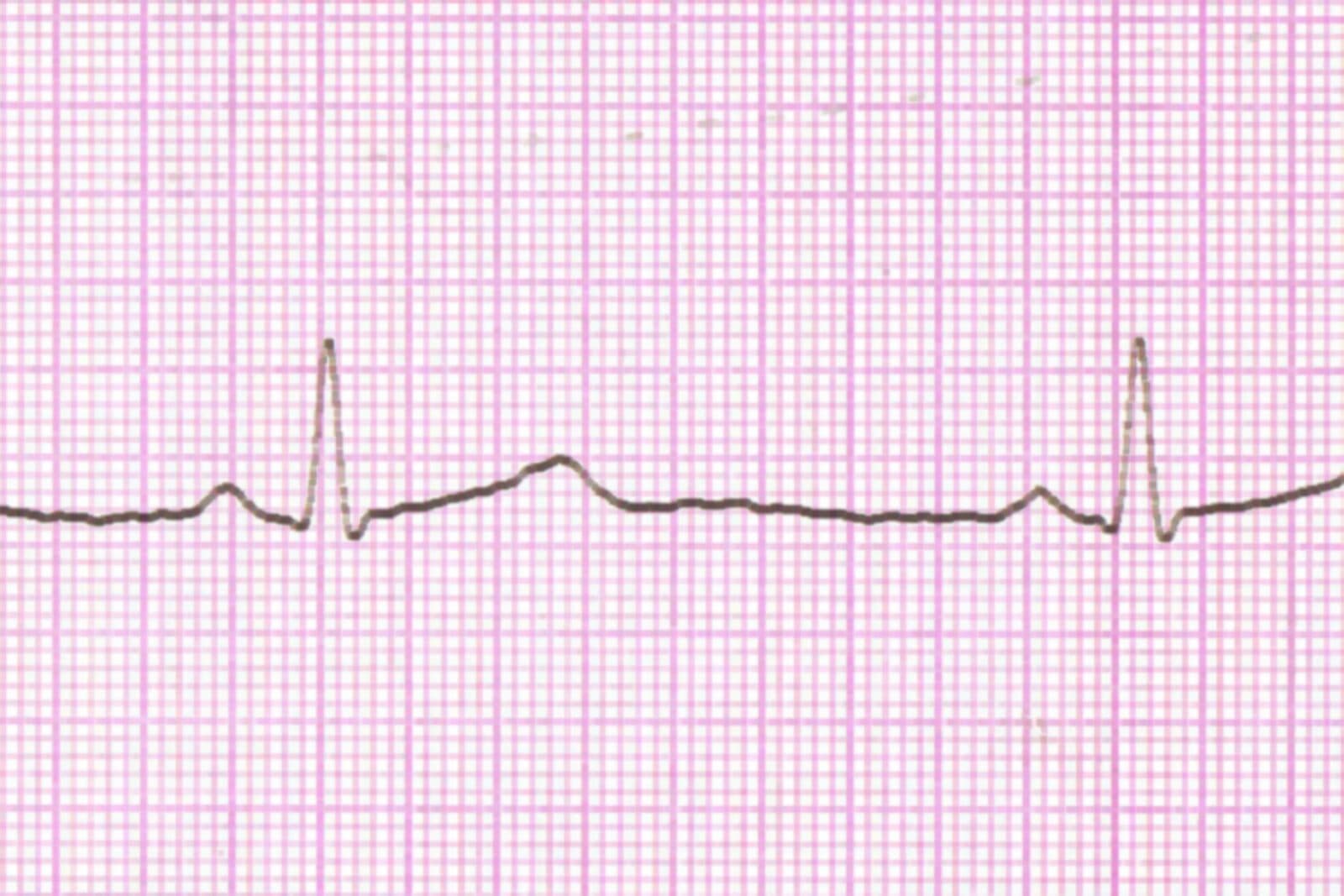 Pembe milimetrik EKG kâğıdı üzerinde iki kalp atımını gösteren EKG çizgisi, yakın plan